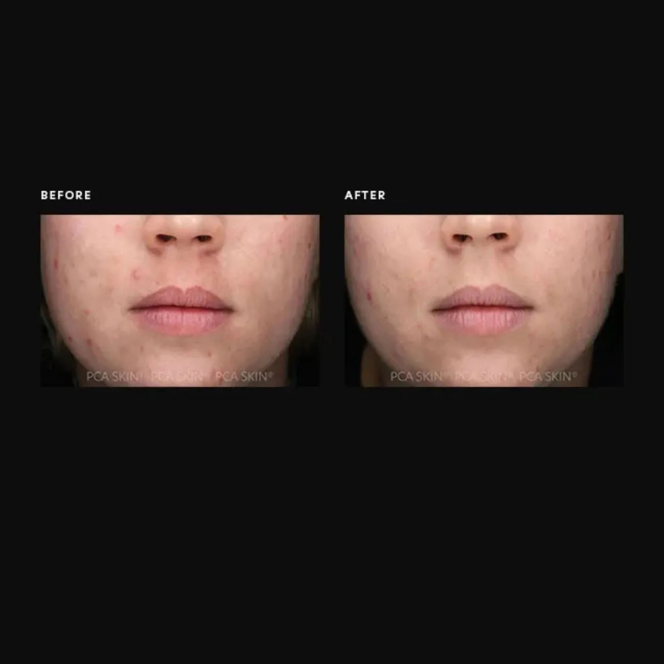 Acne Gel with OmniSome®